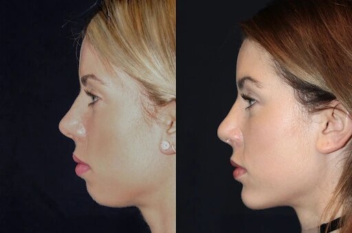 Chin Fillers Treatment in Dubai: Best Clinics for Non-Surgical Enhancement